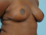 Patient # 45060 After Photo # 4